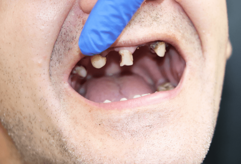 Meth Mouth: Save Your Teeth, Save Your Life